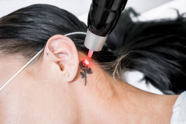 Eliminación de tatuajes